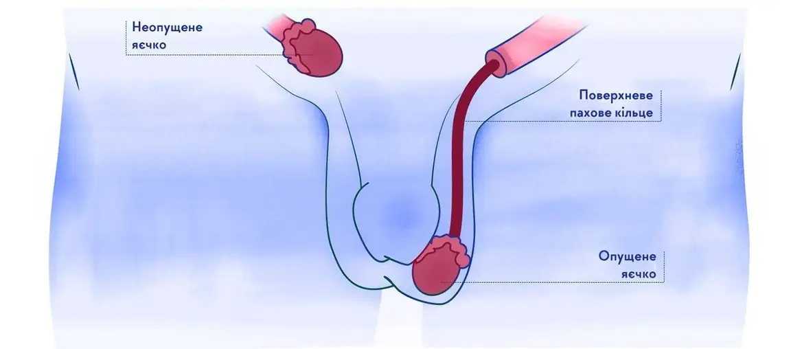 Чоловіча безплідність