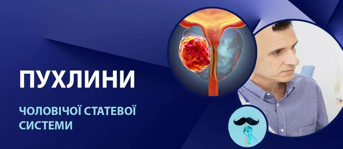 Пухлини чоловічої статевої системи