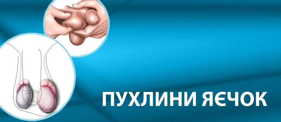 Пухлина яєчка