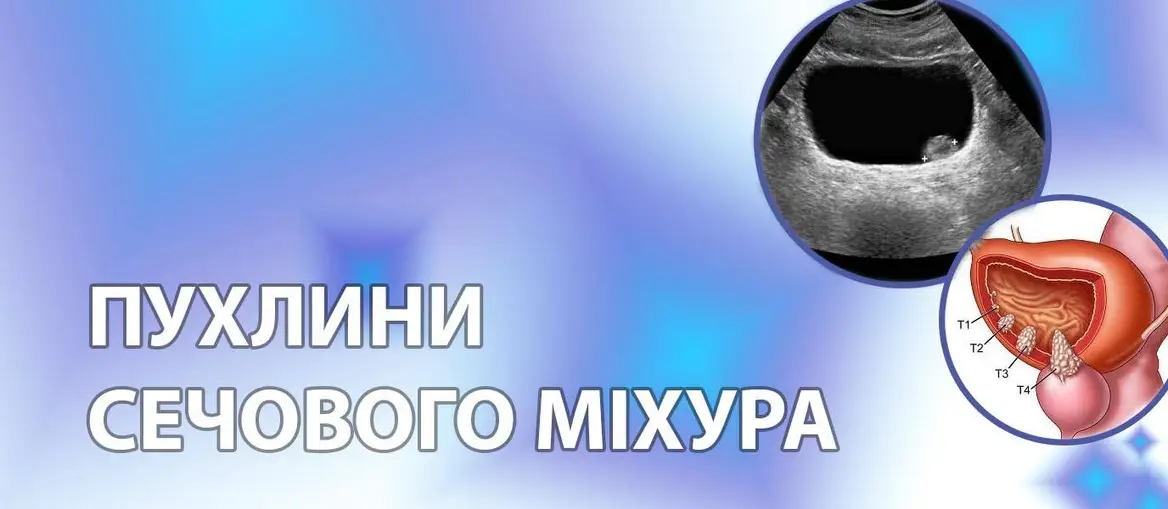 Пухлина сечового міхура
