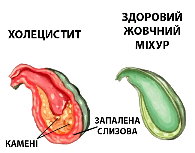 Хронічний холецистит – це захворювання, при якому періодично відбувається запалення стінки жовчного міхура. Це може траплятися внаслідок застою жовчі або інфекційного ураження. Такий запальний процес супроводжується болем у правому підребер'ї, нудотою, блюванням та відригуванням. При перших проявах даного захворювання необхідно звернутися за консультацією спеціаліста.
