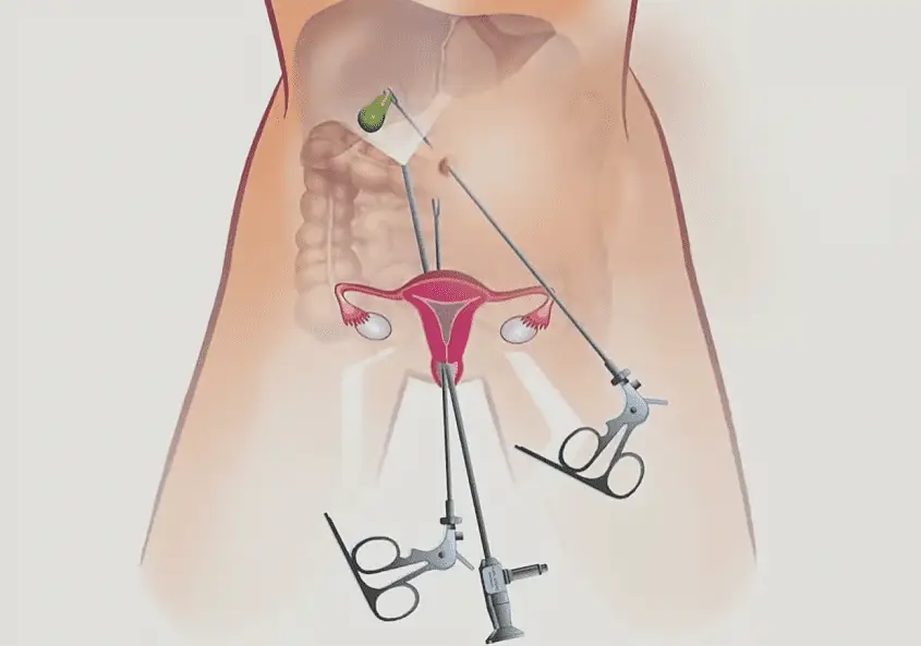 Хронічний холецистит – це захворювання, при якому періодично відбувається запалення стінки жовчного міхура. Це може траплятися внаслідок застою жовчі або інфекційного ураження. Такий запальний процес супроводжується болем у правому підребер'ї, нудотою, блюванням та відригуванням. При перших проявах даного захворювання необхідно звернутися за консультацією спеціаліста.