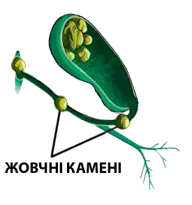 Жовчні камені