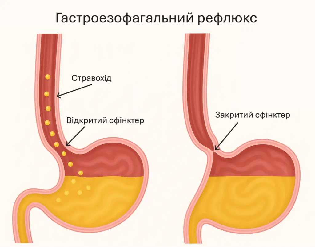 Закидування шлункового соку при гастроезофагеальному рефлюксі провокує запалення.