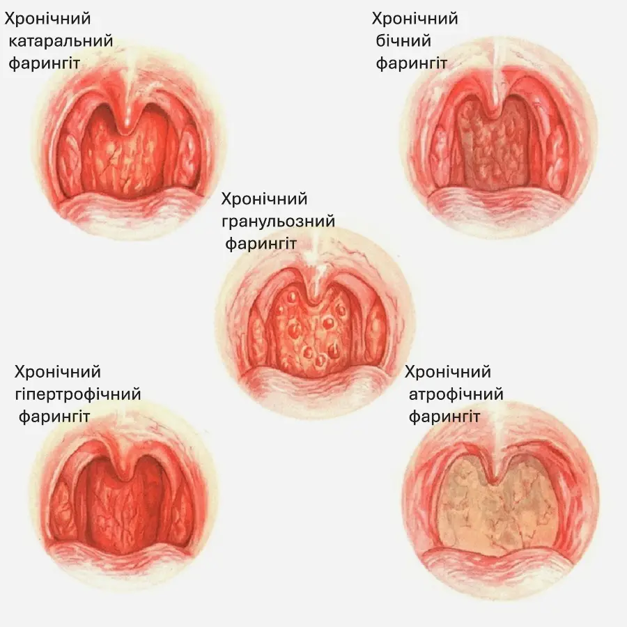 Класифікація фарингітів