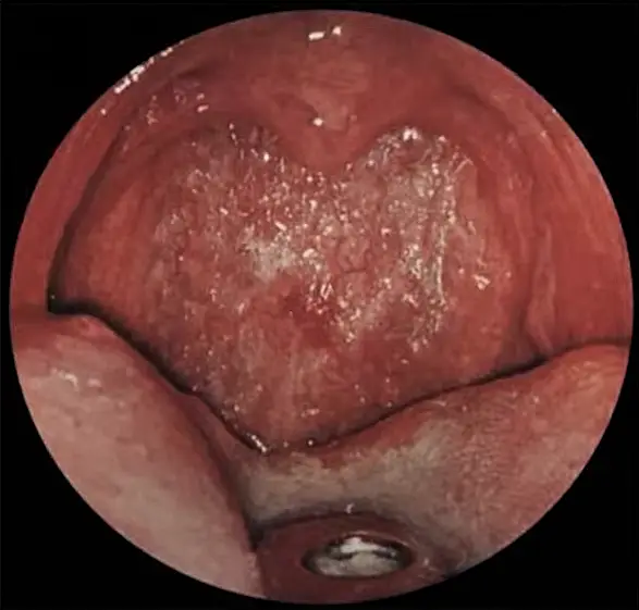 Атрофія слизової оболонки при фарингіті