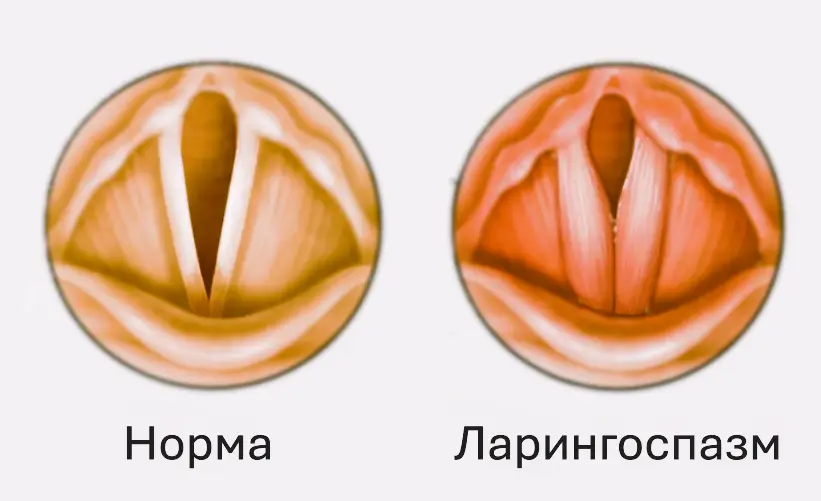 Ком у горлі іноді викликаний короткочасним спазмом голосових зв’язок