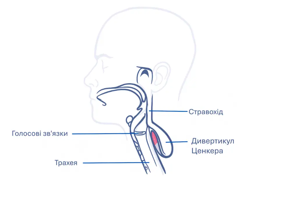 Дивертикул Ценкера – випинання стінки глотки, що може спричиняти відчуття «кому в горлі» та труднощі при ковтанні.
