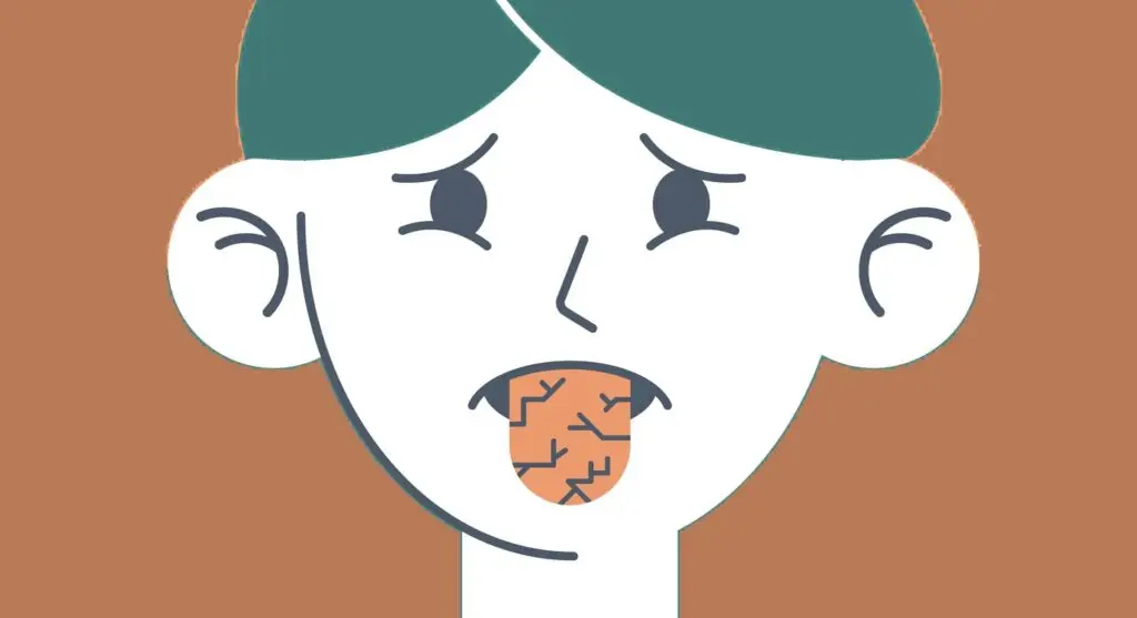 Зменшення слиновиділення при синдромі Шегрена може викликати подразнення та відчуття «кому в горлі».
