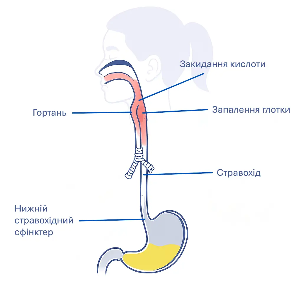 Механізм розвитку ГЕРХ – часта причина відчуття кому в горлі.