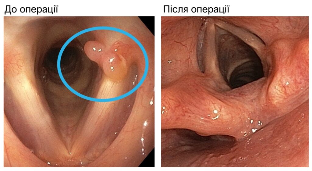Ларингіт: сучасний підхід до діагностики та лікування Ендоскопічне фото папіломи голосових складок до і після видалення