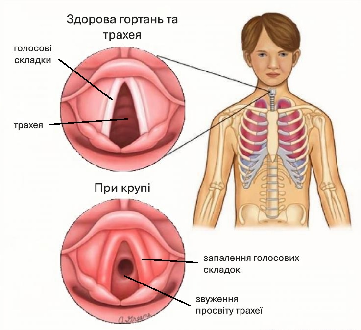 Ларингіт: сучасний підхід до діагностики та лікування При ларингіті спостерігається набряк голосових складок та стеноз трахеї