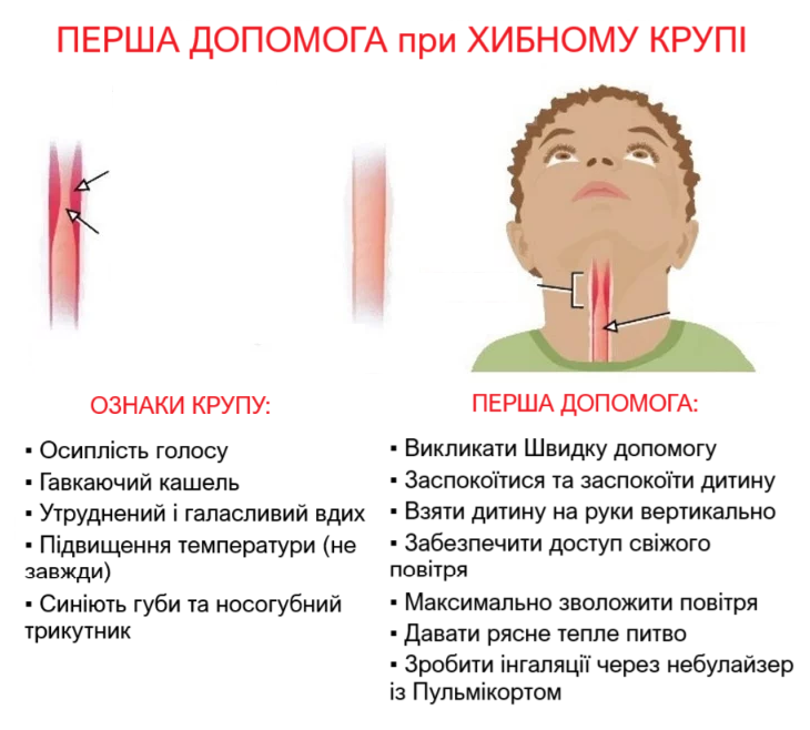 Ларингіт: сучасний підхід до діагностики та лікування Симптоми та перша допомога при крупі, спричиненому ларингітом